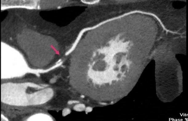 糖尿病胸闷是并发症症状吗,糖尿病突然胸闷原因