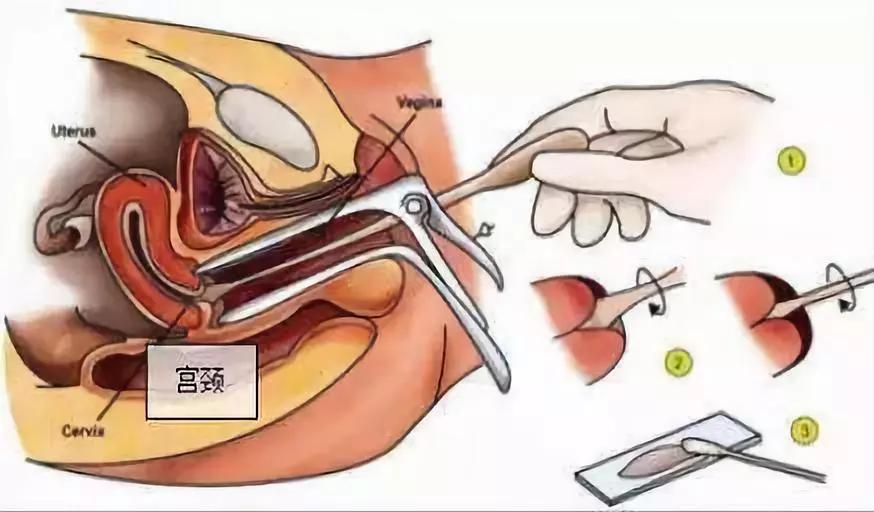 女性宫颈筛查知识大全,女性宫颈筛查的知识