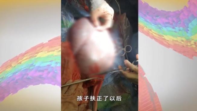 女子怀孕37周肚子巨大无比刨宫产取出25斤囊肿孩子只有5斤4两