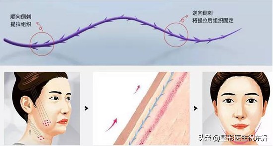 线雕只做一次会有后遗症吗,线雕只提升外轮廓吗