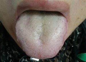 三伏贴除湿气的正确贴法图,三伏贴真的能祛湿气吗