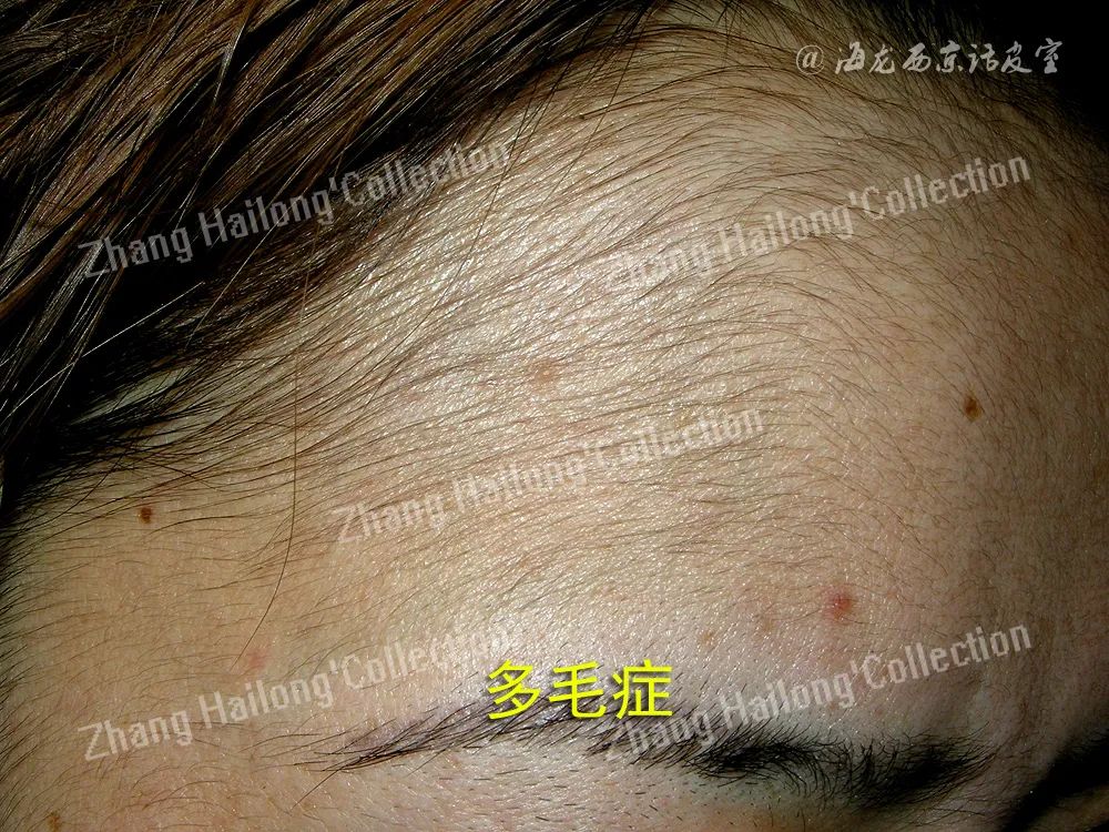 猕猴桃女孩冰点脱毛频率,激光脱毛猕猴桃女孩必备