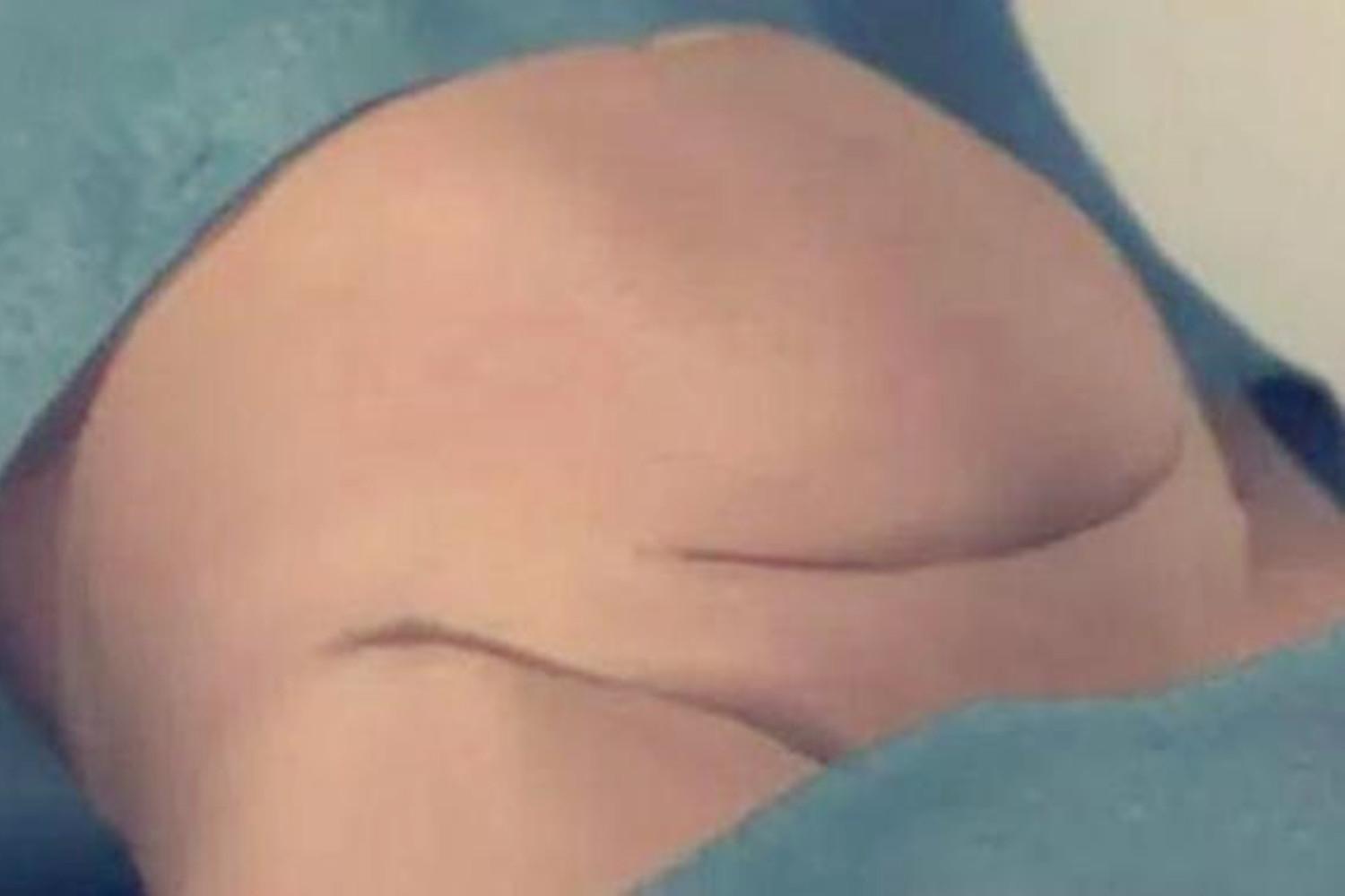 剖腹产肚子上最多能挨几刀,剖腹产完打的肚皮针是什么