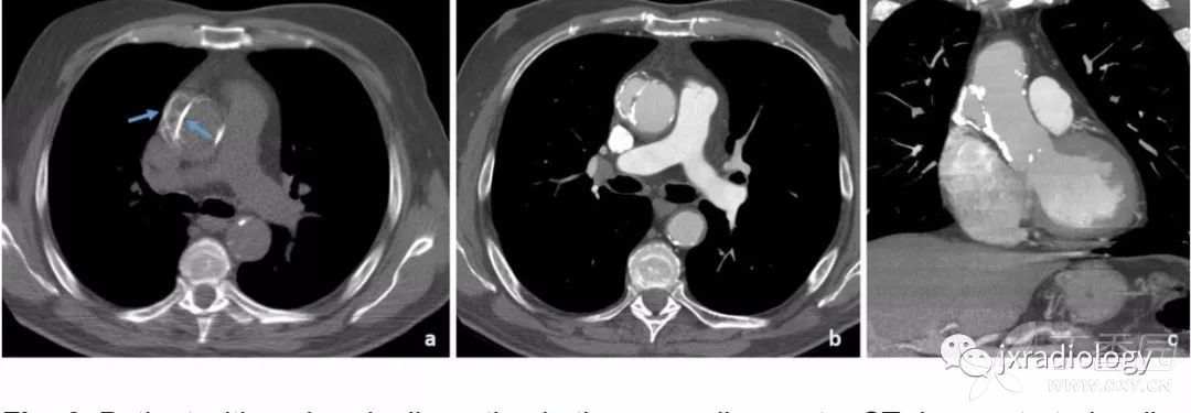 急性主动脉综合征报道,急性主动脉综合征症状