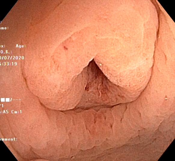 怎么让阑尾炎不复发,不开刀也能治愈阑尾炎