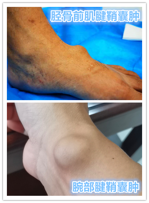 腱鞘囊肿开刀会留多大的疤,手腕腱鞘囊肿开刀的流程