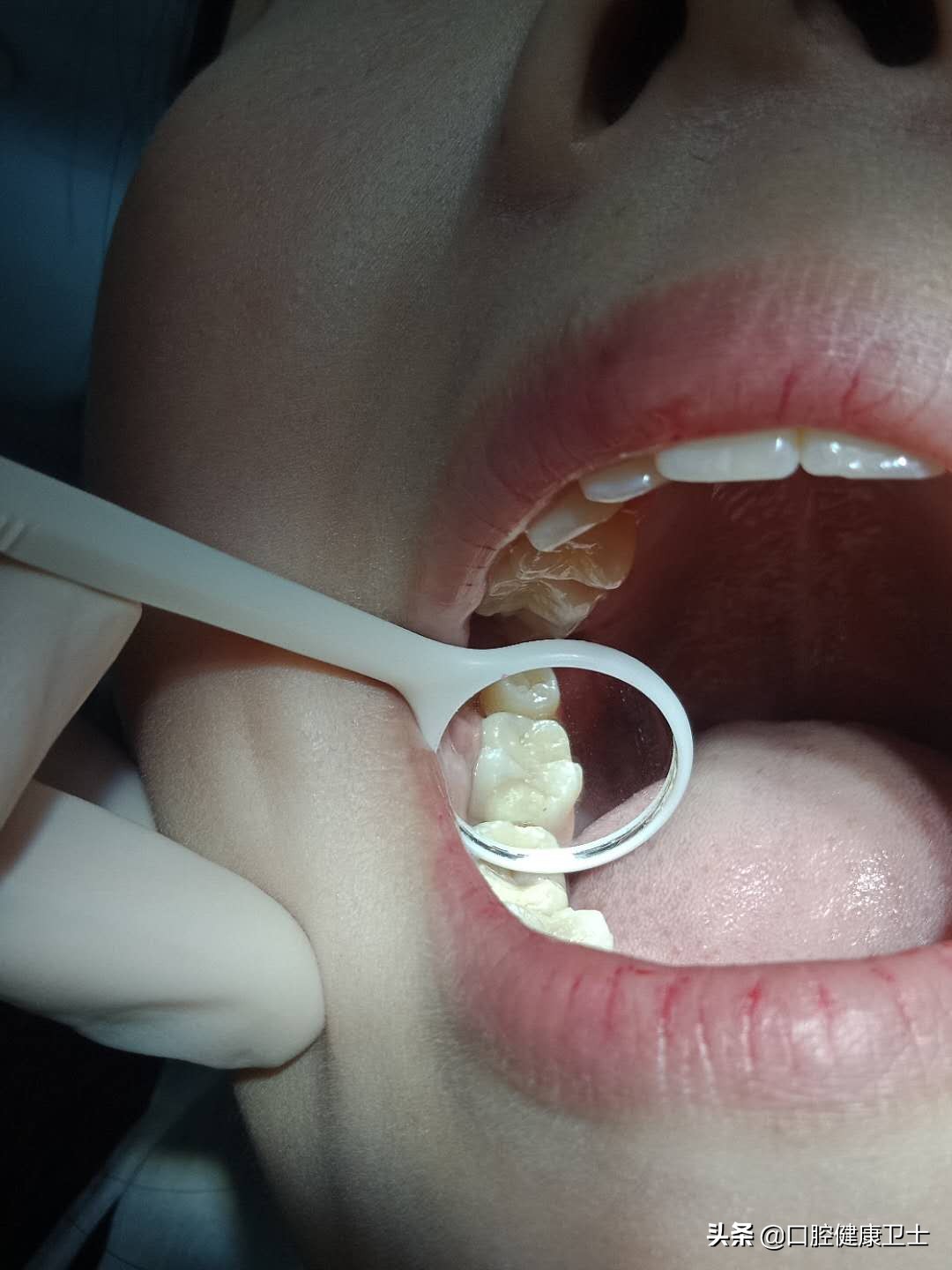 补牙后感觉牙缝被堵上了,补牙后牙缝疼痛是什么原因引起的