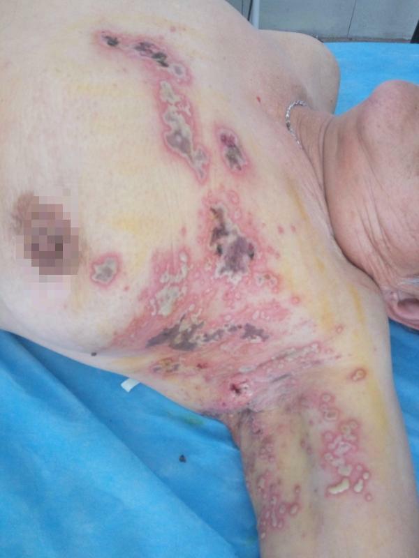 带状疱疹好治疗吗,带状疱疹合并糖尿病为什么难治