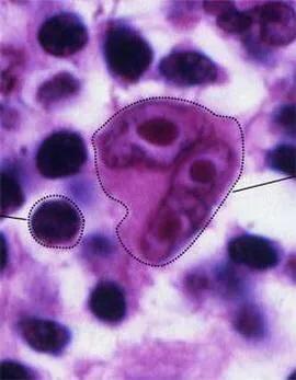 普通盗汗与艾滋病盗汗,艾滋病导致结核病才夜间盗汗吗