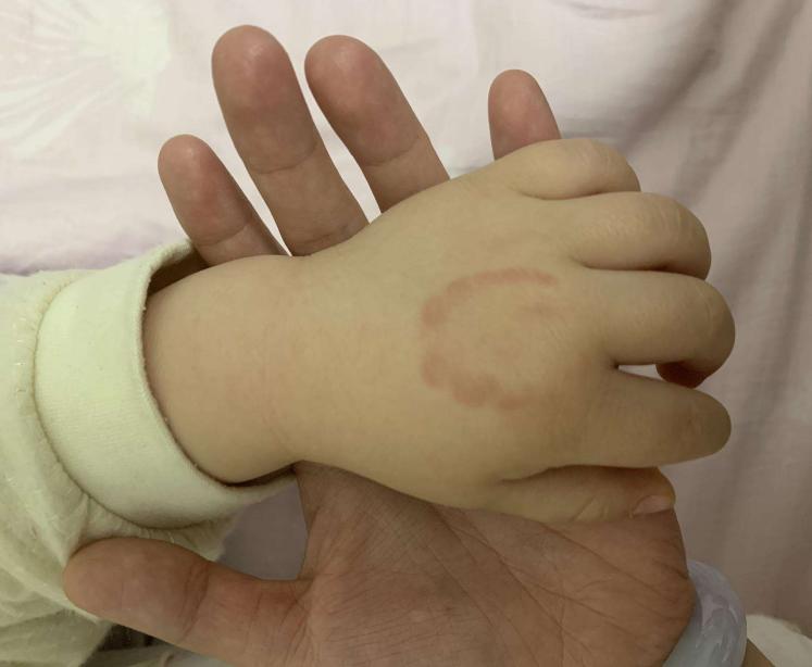 小孩在幼儿园被小朋友咬伤,孩子在幼儿园被其他小孩咬伤