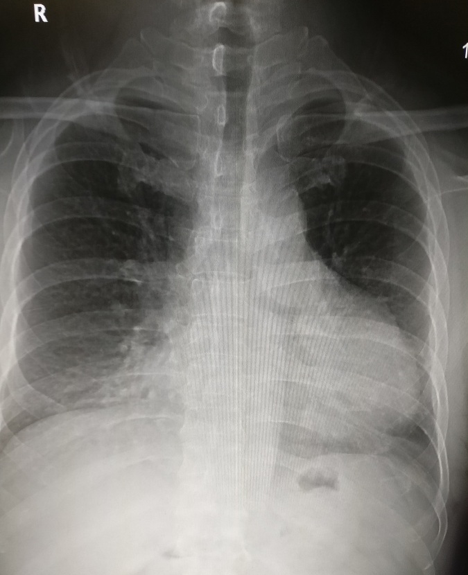 循环系统胸片,体循环和肺循环临床表现