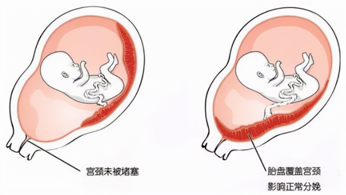 前置胎盘很凶怎么回事,前置胎盘真的有那么可怕吗