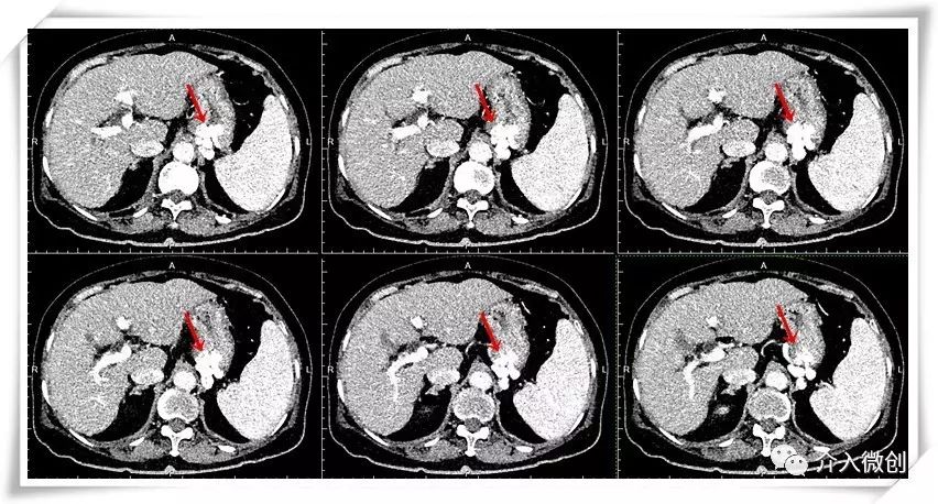 门静脉高压介入治疗好吗,缓解门静脉高压微创手术