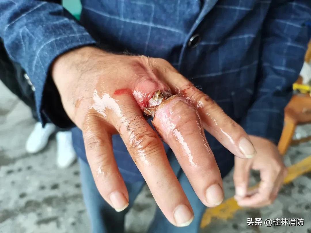 女子戒指卡手手指腐烂,男子戒指卡手消防救援巧脱险