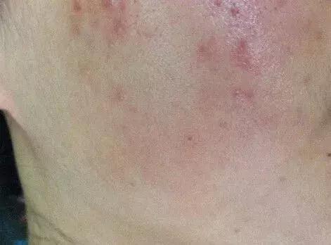 脸上的痘印用药膏可以彻底去除嘛,脸上的痘印可以消除吗