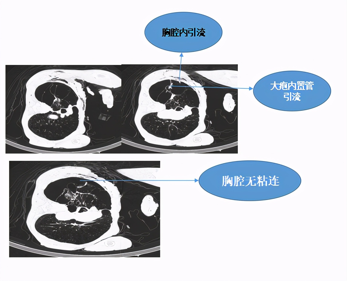 中国第一例肺移植病人,哪个医院能肺移植