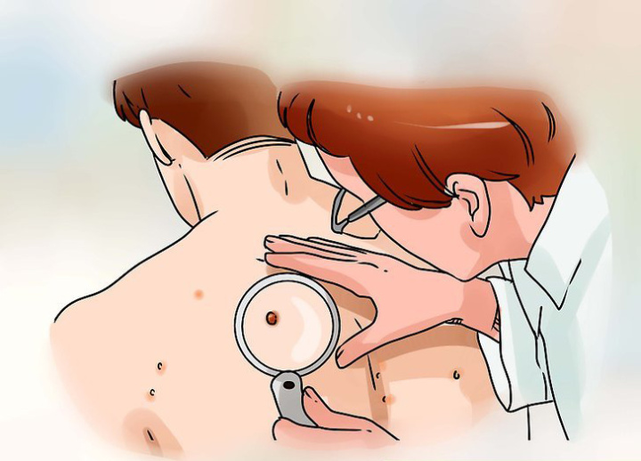5种痣要小心可能会恶变,这5种痣有恶变的可能需重视