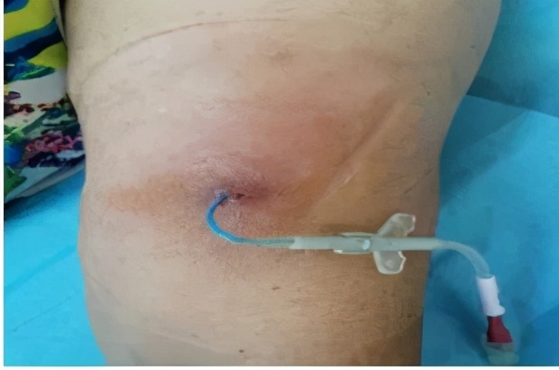 碘伏治疗伤口吗,碘伏治疗伤口发炎吗