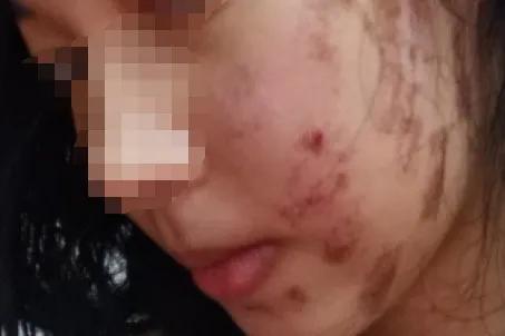 广西女子毁容后续,一妇女惨遭毁容