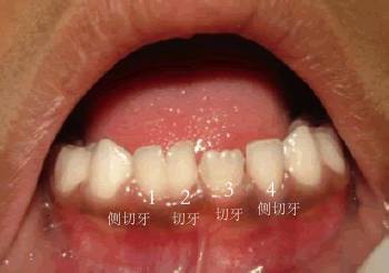 牙齿长成包谷牙怎么办,牙齿长成了双排牙如何矫正