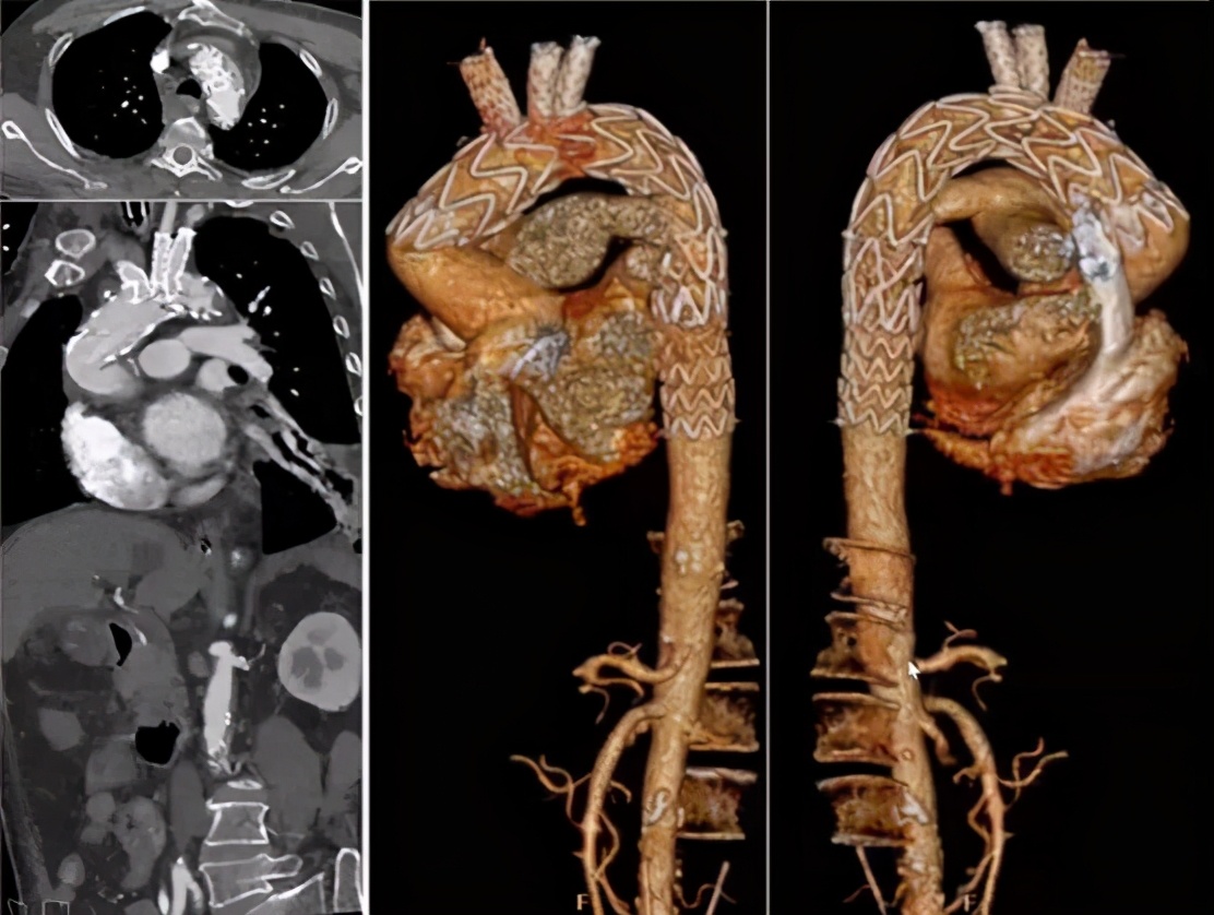 胡佳:升主动脉近端手术后新发弓部病变的腔内治疗