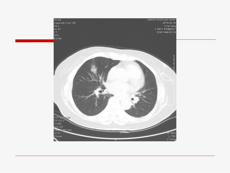 像炎症的肺癌能治好吗,医生说可能是肺癌也可能是炎症