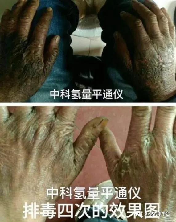 中氢平通仪真的能排毒吗,中科氢量平通仪真的有效果吗