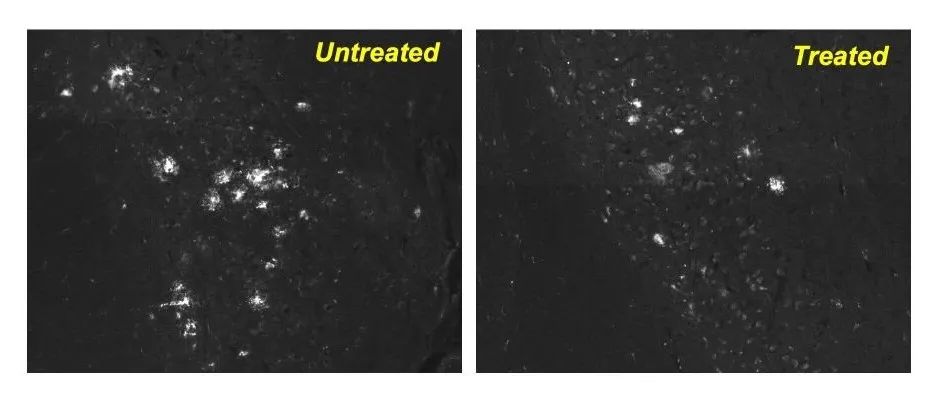治疗阿尔茨海默病最新研究,目前抗脑衰的研究成果