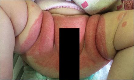 尿布疹会引起哪些症状呢,顽固性尿布疹能引起银屑病吗