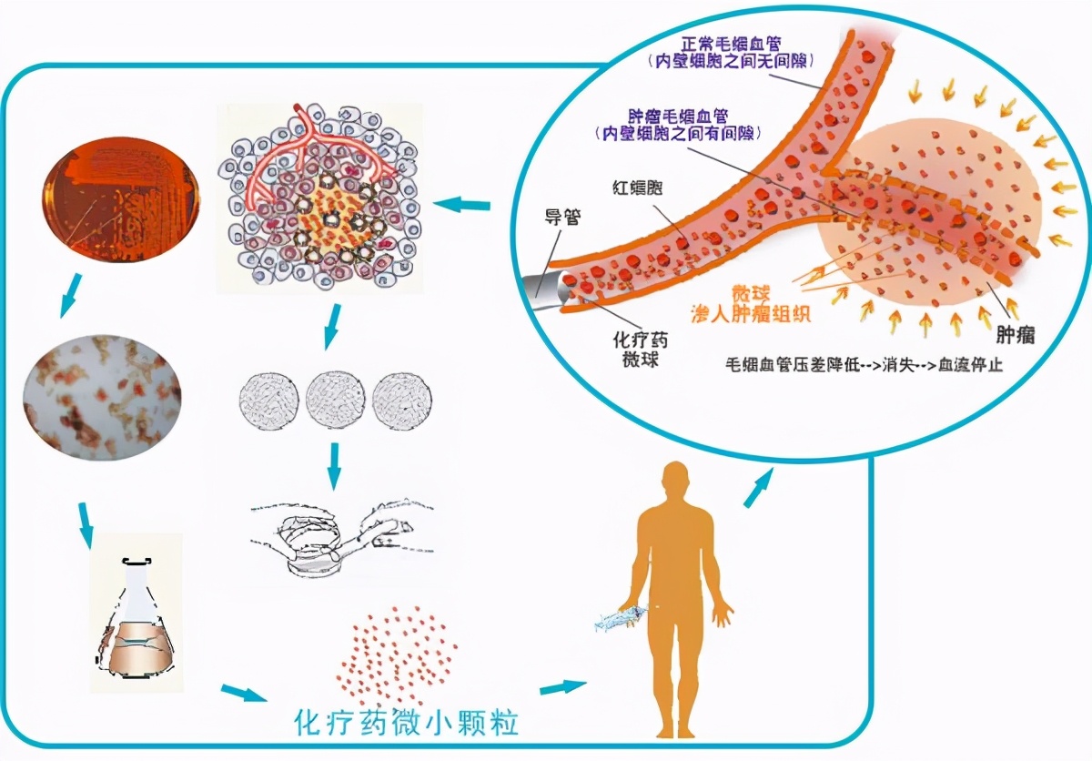 微创介入治疗肿瘤,介入治疗对肿瘤有效吗