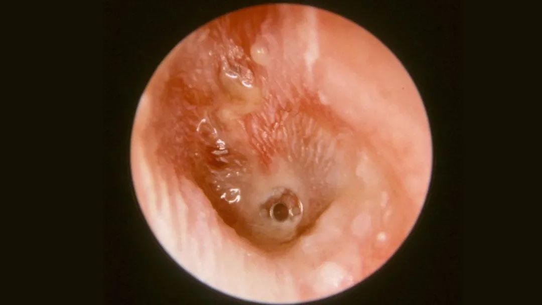 预防宝宝中耳炎的对策,儿童患急性中耳炎轻度应密切观察