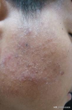 误把股癣当湿疹,错把特应性皮炎当湿疹治