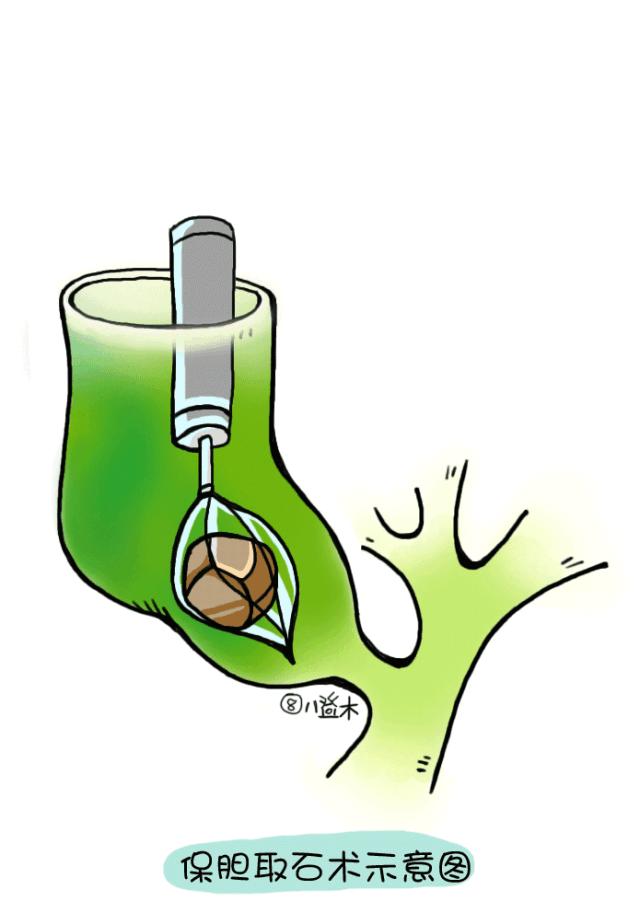 被结石折磨得体无完肤,双镜联合下胆囊切开取石术费用
