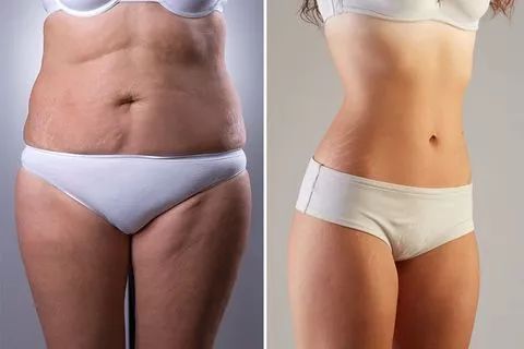 瘦下来橘皮会消失吗,橘皮组织肥胖怎么办