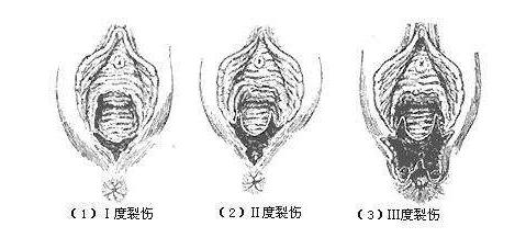 软产道损伤修补时的注意事项,软产道损伤的危害