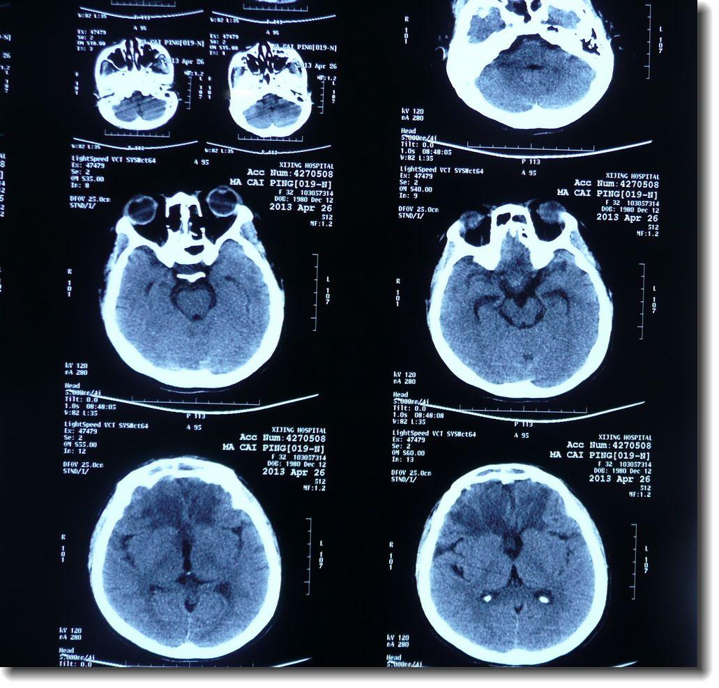 最常见的先天性脊柱侧凸的病因,先天性脊柱凸起怎么治疗