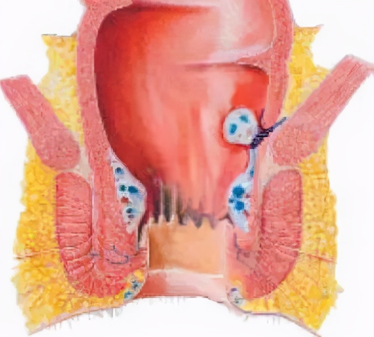痔疮手术当天去医院就能做吗,两天后能出院的痔疮手术