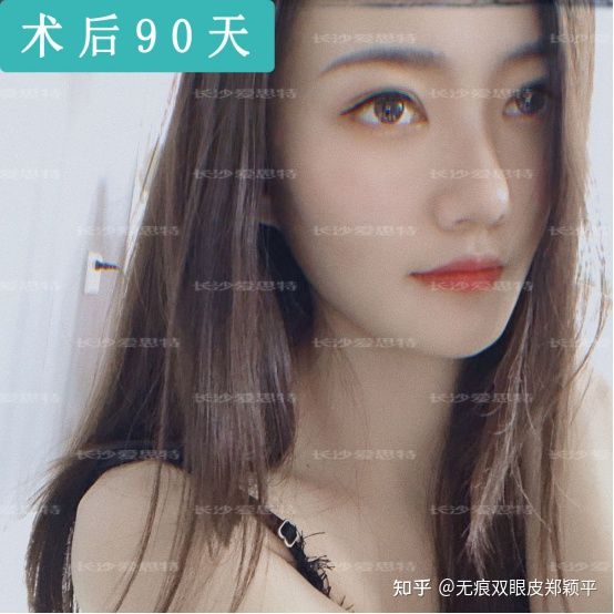 刚割双眼皮的样子,割双眼皮增生是什么样子