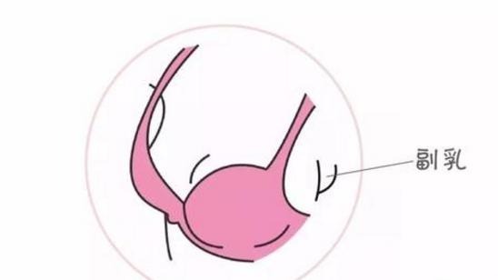 产妇腋下副乳硬块怎么消除才正确,副乳就是腋下的两坨赘肉