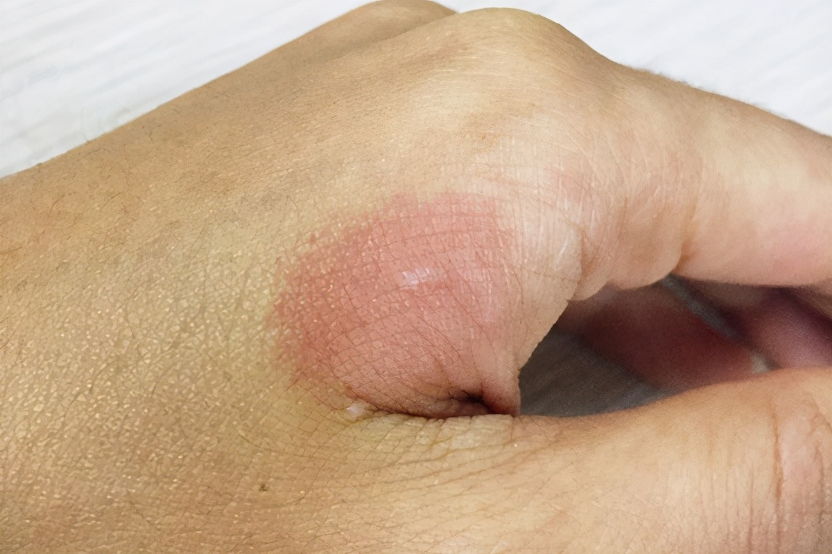 女孩油皮换季脸部起皮泛红,脸部干燥起皮屑是什么原因