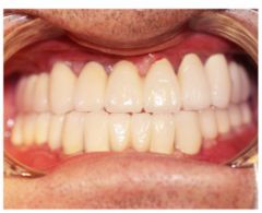 满口缺牙如何补牙,满口缺牙怎么办