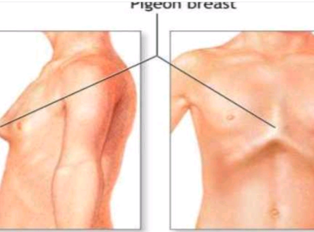 儿童缺钙鸡胸表现,鸡胸缺钙如何消除