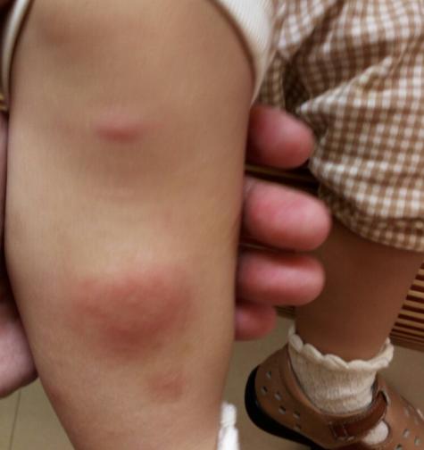 青草膏小孩能用吗,青草止痒膏