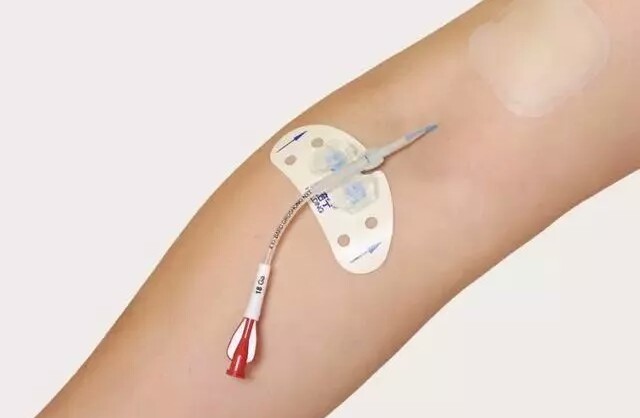 化疗时为什么要置PICC中心静脉导管、或埋输液港呢？