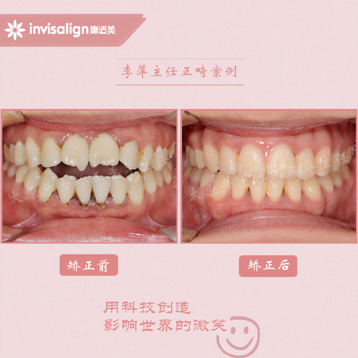成都牙齿有缝隙怎么矫正,牙齿拥挤矫正前两天不痛正常吗
