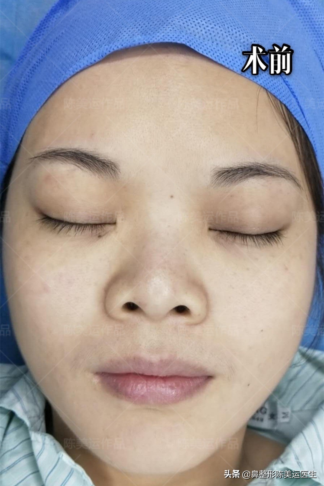 短塌鼻子可以做成直鼻吗,塌鼻子怎么能变成尖鼻子