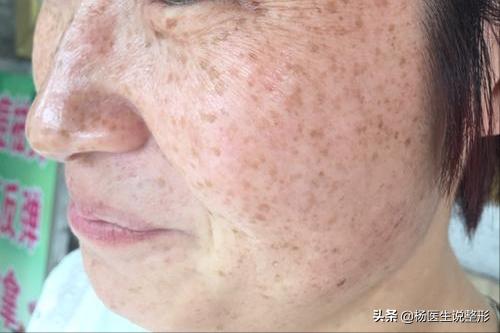 遗传雀斑激光祛斑最真实的经历,遗传性雀斑用激光祛斑的费用