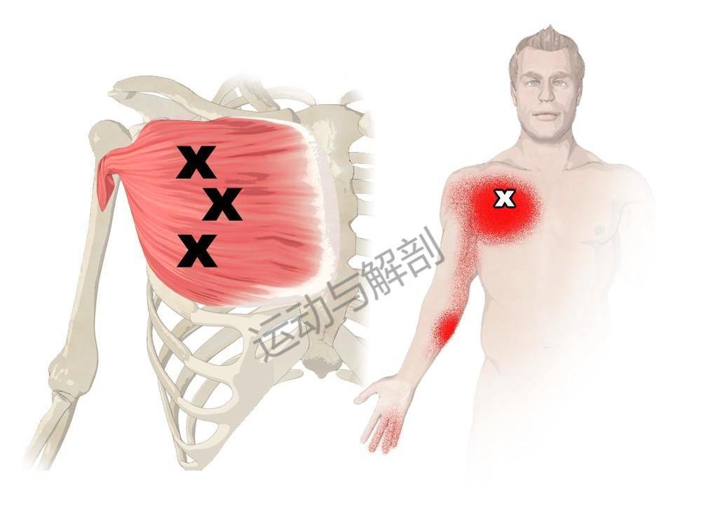 胸大肌肌肉撕裂怎么更快恢复,胸大肌疼痛怎么消除