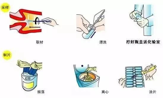 试管前为啥检查hpv和tct,做试管婴儿需要查孕酮吗