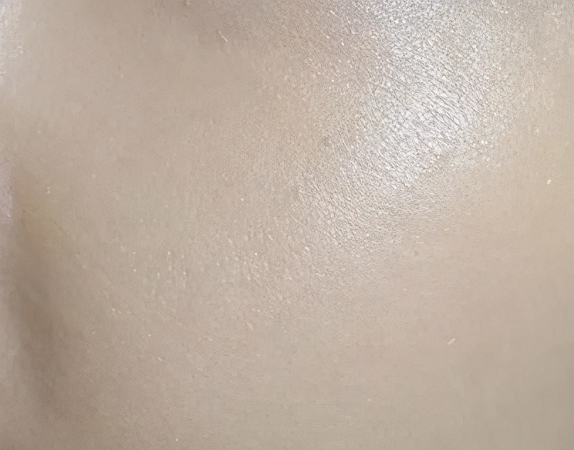 皮肤粗糙毛孔粗大最快的解决办法,皮肤松弛毛孔粗大黑头多怎么解决